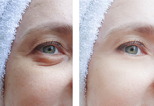 How to Get Rid of Puffy Eyes or Eye Bags Naturally