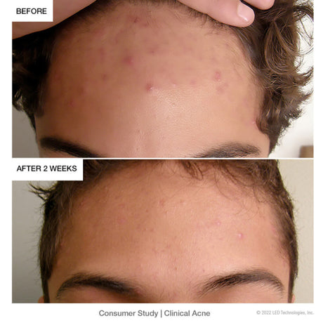 Open Box Clinical Acne
